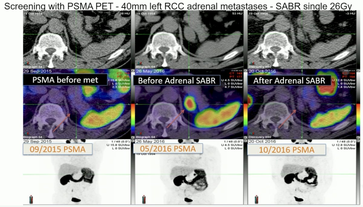 screening with PSMA PET imaging and treating metastases with stereotactic ablative radiation therapy, followed by assessment of treatment response with subsequent PSMA PET imaging