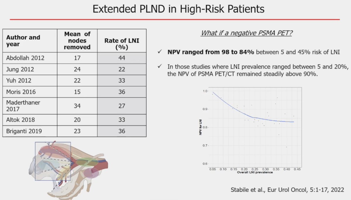 Extended pelvic lymph node dissections in high-risk patients