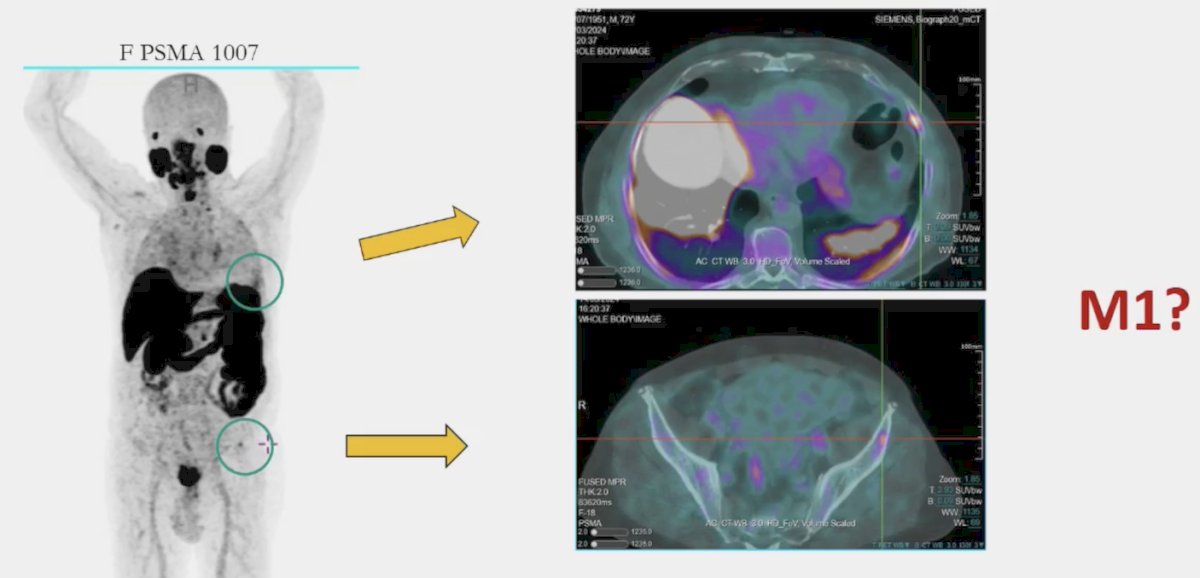 8F-PSMA-1007 has non specific uptake in bone marrow which may lead to false positive bony lesions