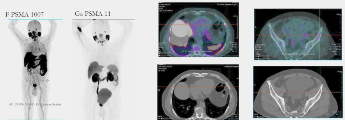 rescanned with 68Ga-PSMA-11, there was no evidence of a rib lesion