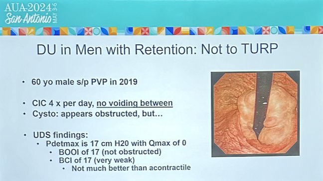 DU in Men with retention NOT IN TURP