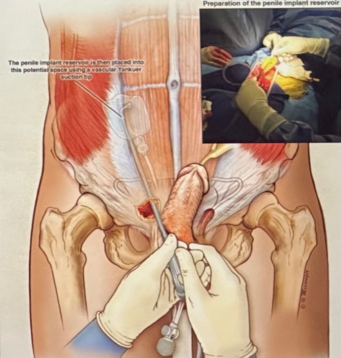 penile prosthesis illustration