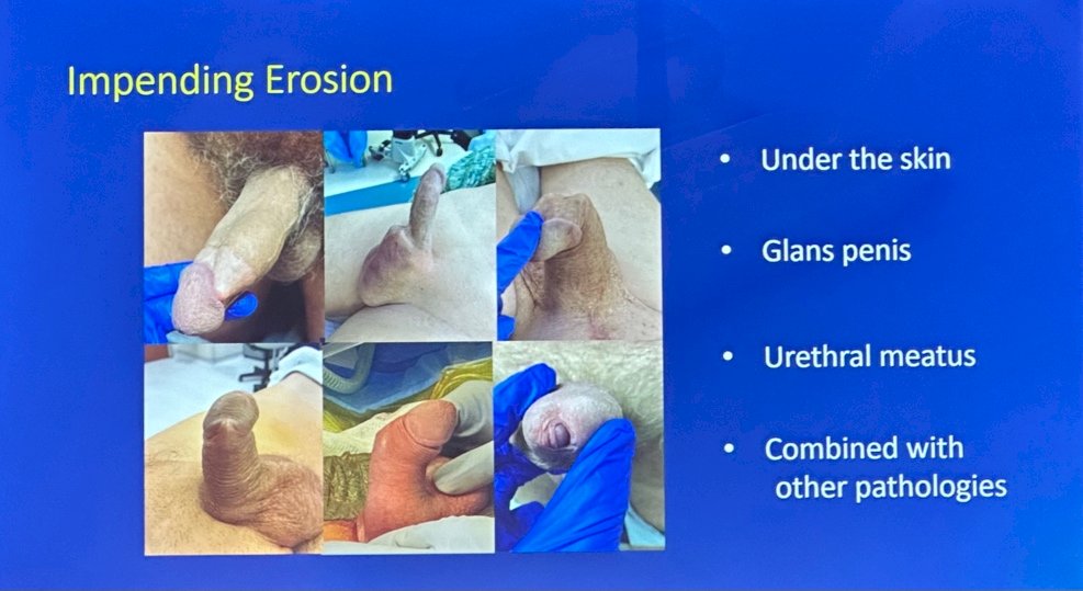 penile prosthesis surgery impending erosion