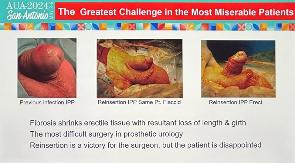 penile prosthesis surgery greatest challenges