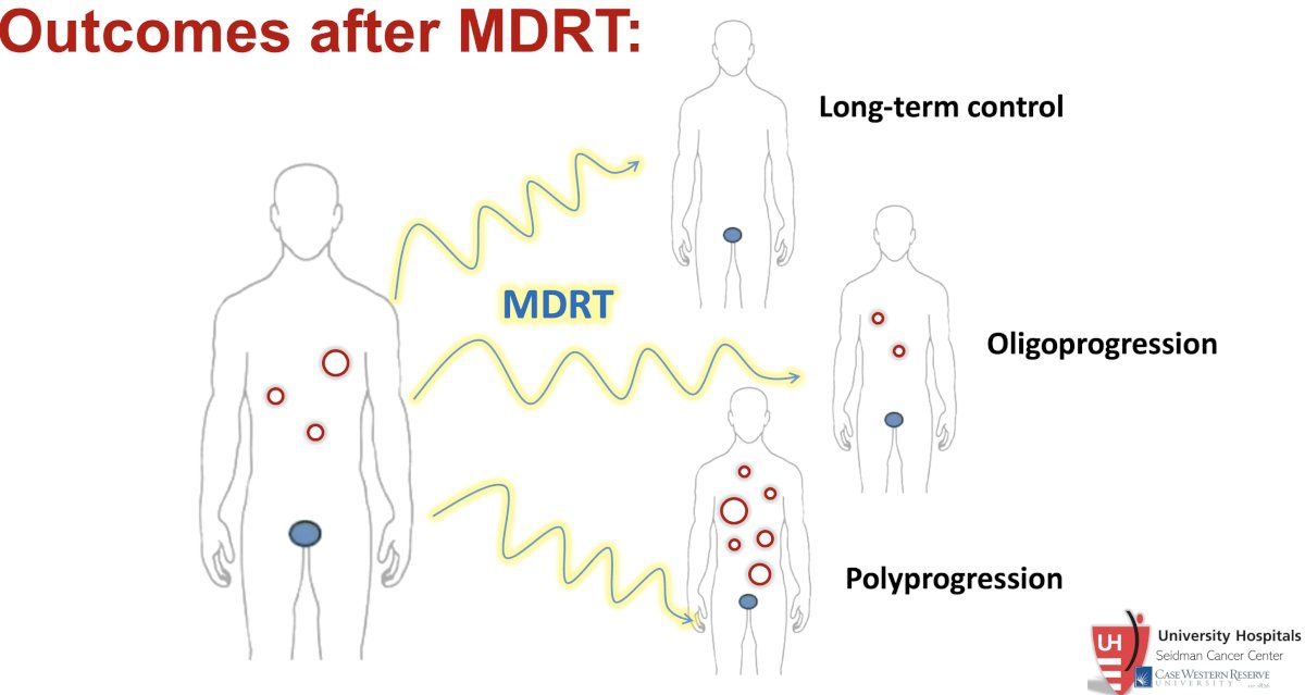 Following MDT with SABR