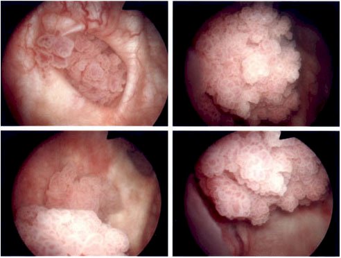 68 year old male with a history of hypertension, coronary artery disease, obesity, and previous tobacco use, who presented with gross hematuria cystoscopy images
