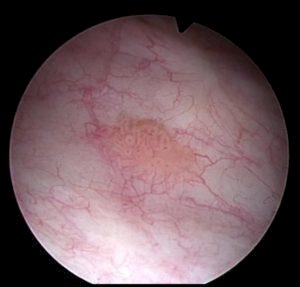 3 month cystoscopy that showed 2-3 small (<5 mm) papillary lesions scattered throughout the bladder, with a low grade Ta appearance
