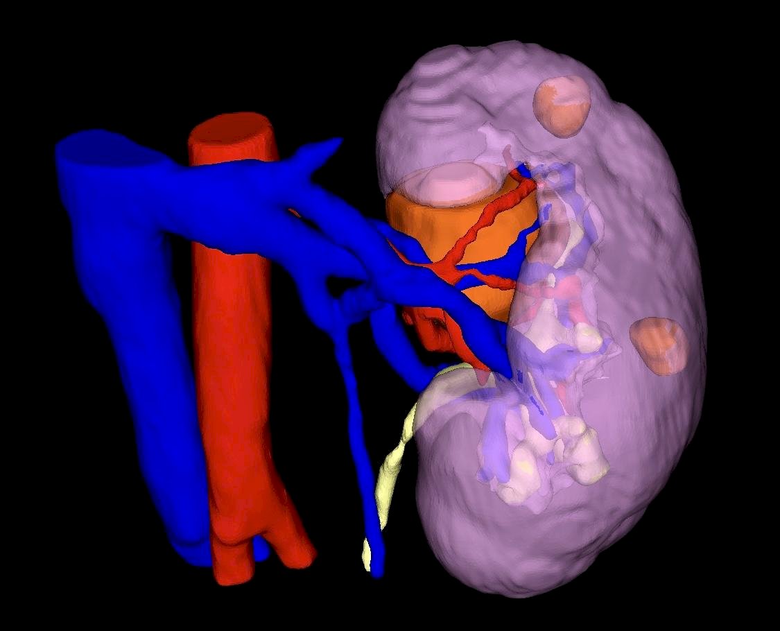 IRIS™ is a 3D rendering of a patients CT scan