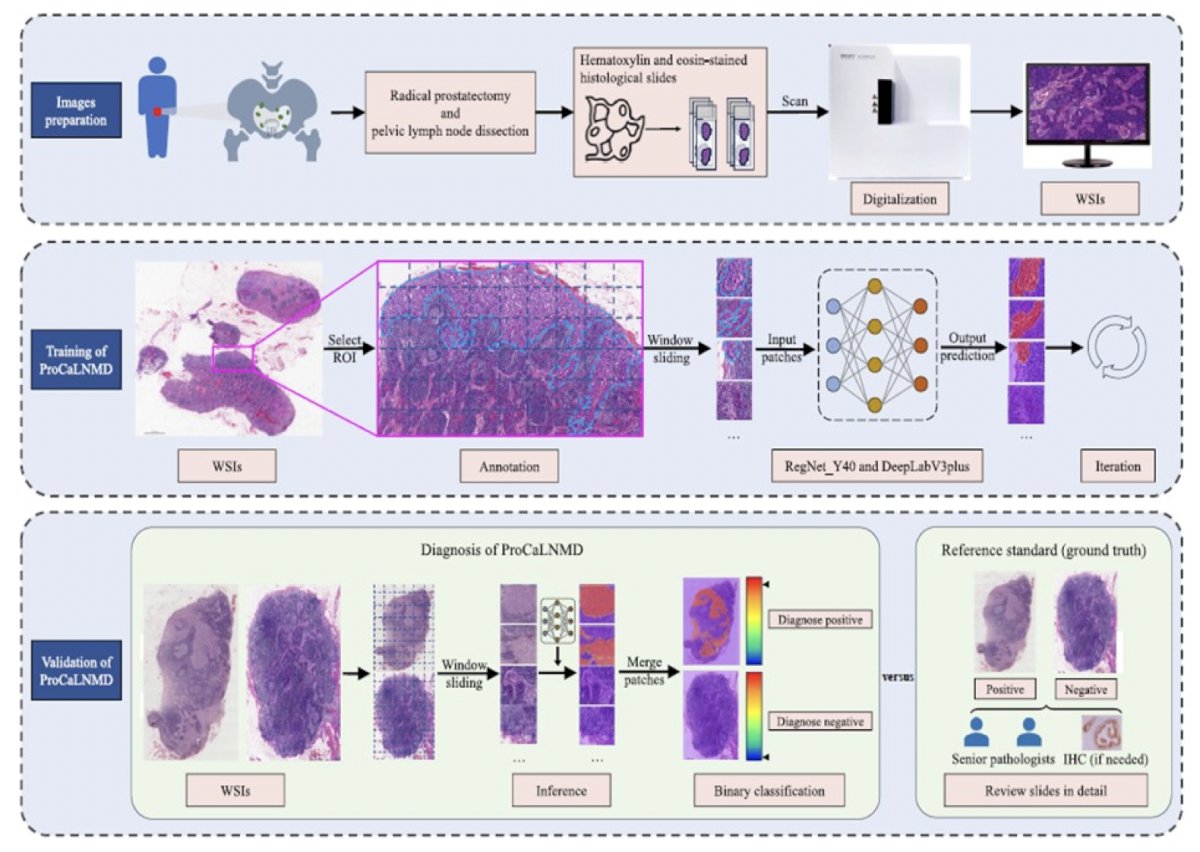 image-0.jpgtudy assessing artificial intelligence modeling for detecting pathological lymph node metastasis, the following workflow was utilized