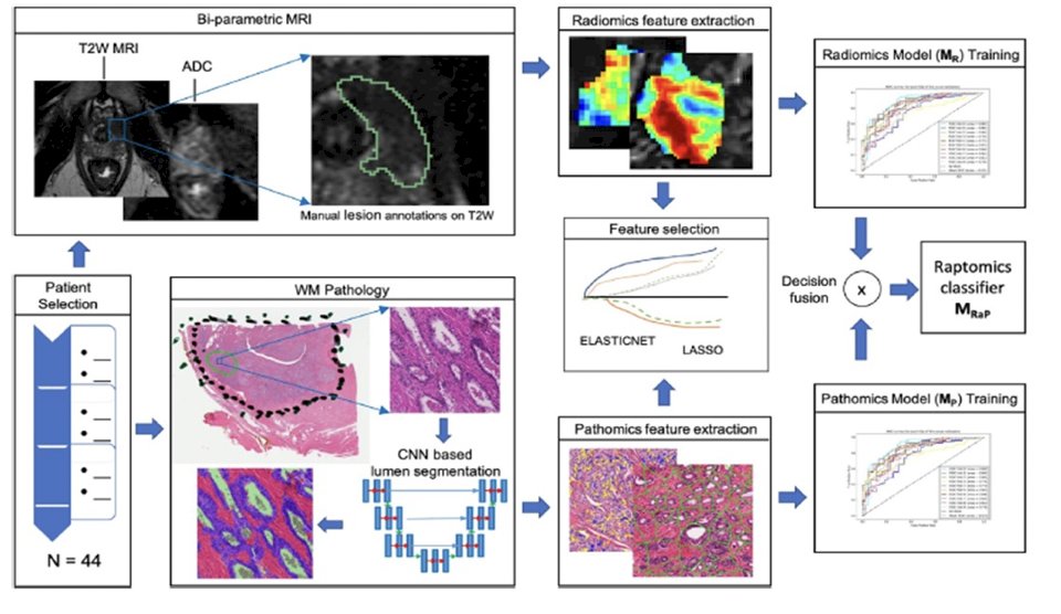 Hiremath et al. recently evaluated the added benefit of integrating features from pre-treatment MRI (radiomics) and digitized post-surgical pathology slides (pathomics) in prostate cancer patients for prognosticating outcomes post radical-prostatectomy