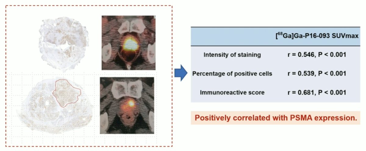 68Ga-P16-093 PET/CT SUVmax was also correlated with Gleason score (biopsy pathology slides) (r = 0.395, p = 0.002)