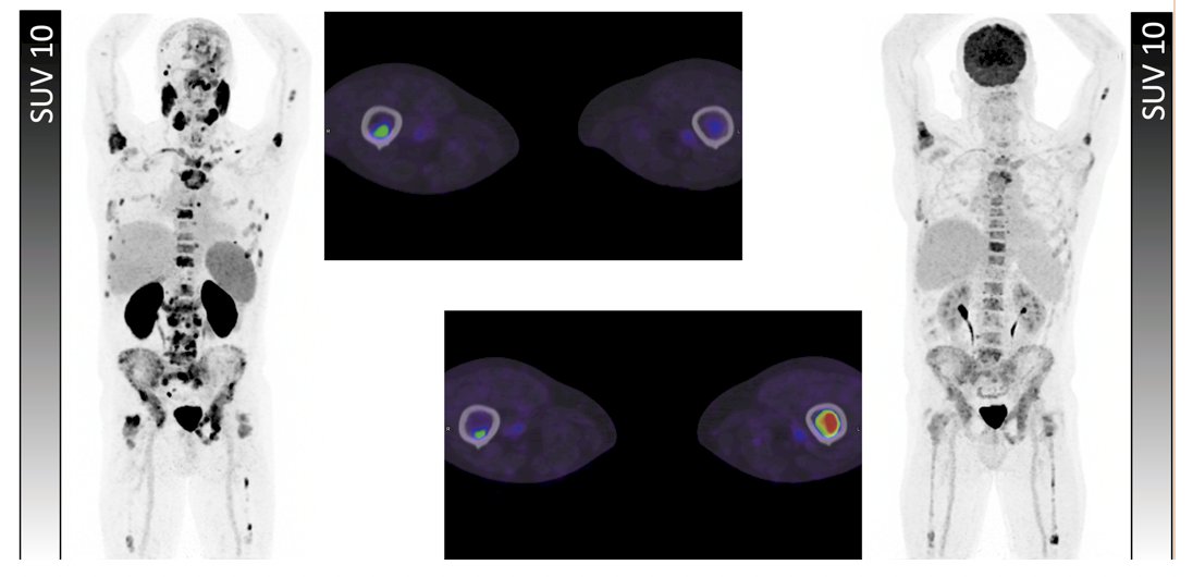 67 year old with metastatic castration resistant prostate cancer who was eligible for radioligand therapy based on VISION criteria, but ineligible based on 3TMPOA, 3TMPOB, and TheraP (FDG+/PSMA- bone lesions)