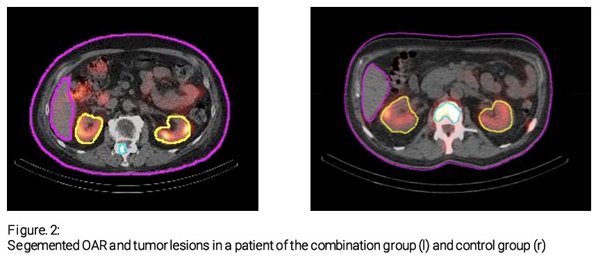 Quantitative abdominal SPECT images