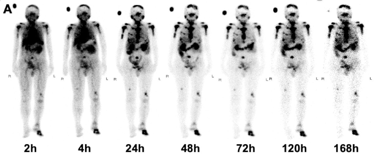 representative whole-body anterior projective images taken at multiple time points within one week for an 80 year old male with metastatic castration resistant prostate cancer who received 177Lu-LNC1011 at a dose of 2.78 GBq. Tumor uptake remained high at 168 hours