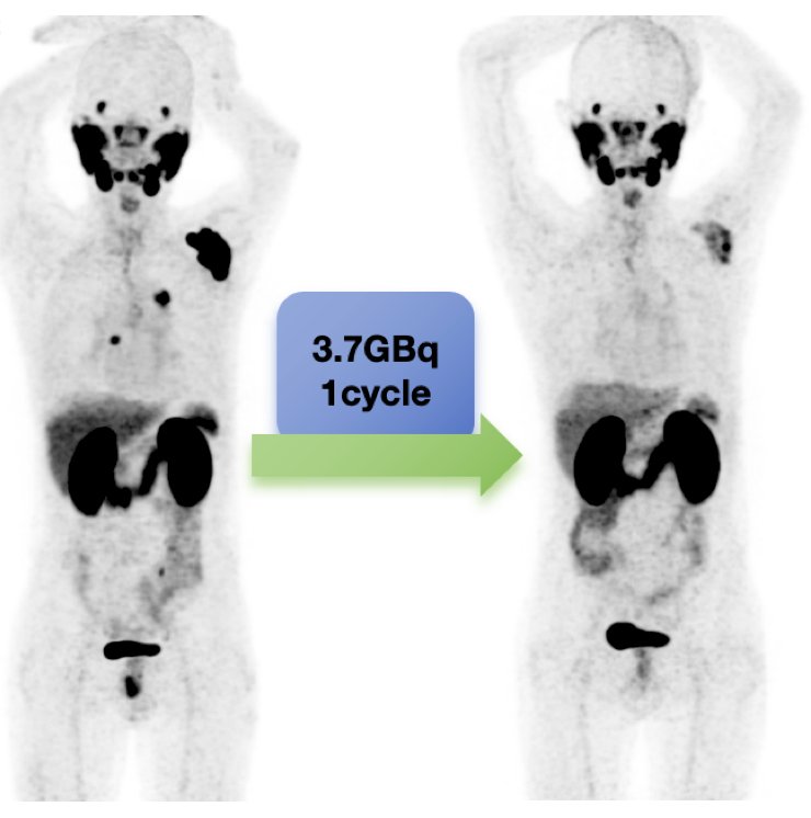 65 year old male patient after undergoing one cycle of 177Lu-LNC1011 treatment with a dosage of 3.7 GBq who exhibited a remarkable therapeutic response