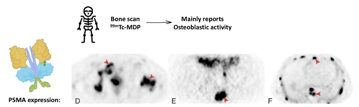 M-staging, 99mTc-MDP bone scan mainly reported osteoblastic activity. But based on PSMA expression, are these indeed osteoblastic lesions