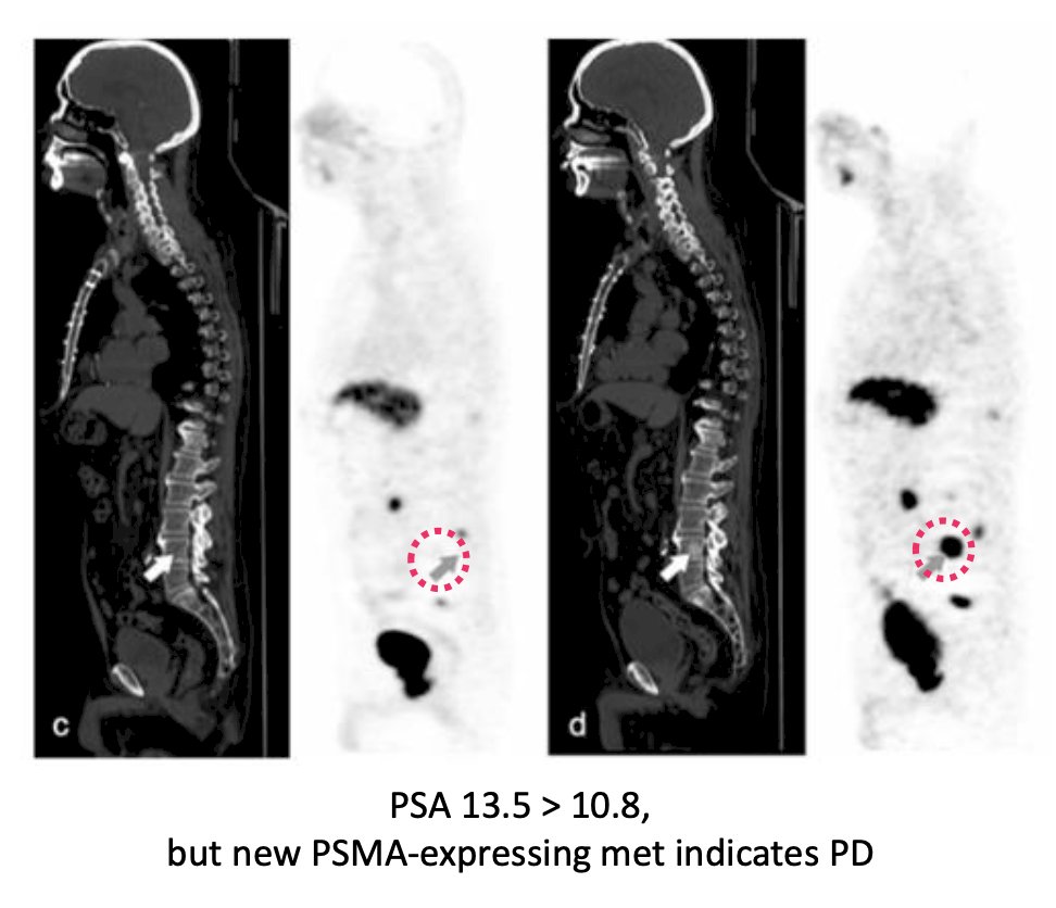 total volume of PSMA expression suggests that more equals bad disease. Additionally, even in situations where there is only a slight increase in PSA, new PSMA expression metastases indicates progressive disease