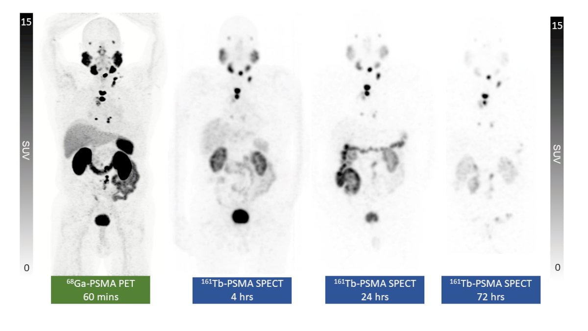 12 patients received their first cycle of 161Tb-PSMA-I&T in the dose escalation phase. The quality of the SPECT/CT images was visually similar to those acquired post-177Lu-PSMA
