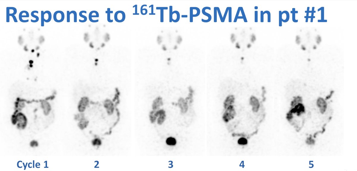 response to 161Tb-PSMA-I&T in patient #1 (PSA decline to 5 cycles of treatment: 16   0.7 ng/mL)
