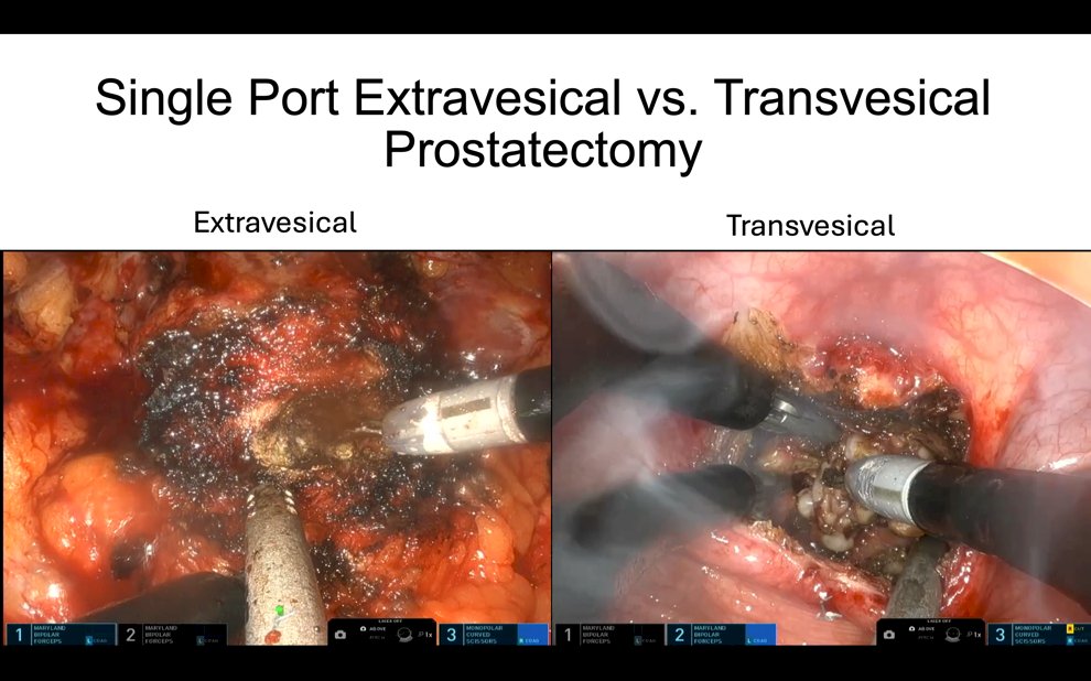 Single Port Extravesical vs. Transvesical prostatectomy 2