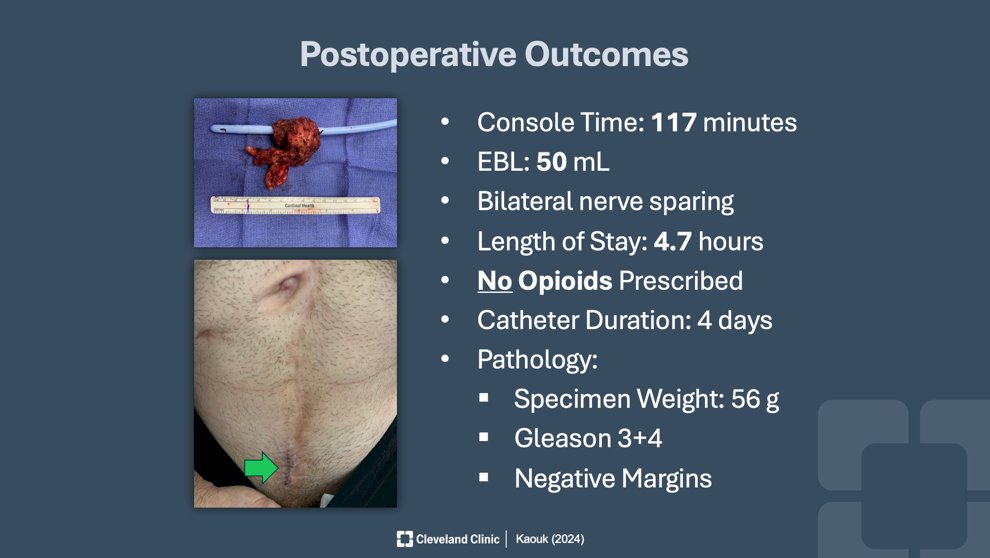 further data is needed to substantiate this; more surgical data regarding the transvesical approach’s post-operative outcomes are in the image below.