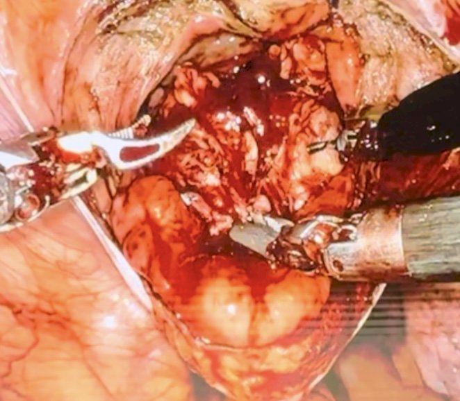 Figure 2. Removal of adenoma.