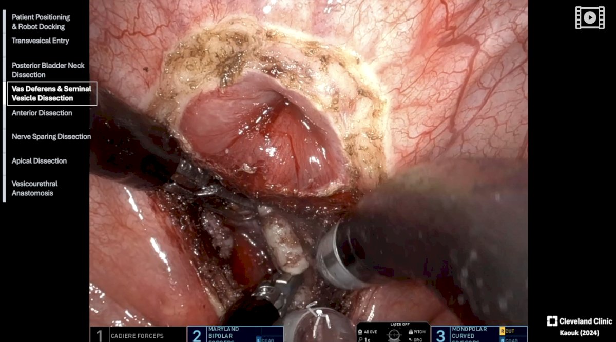 prefers not to change the camera position during the procedure, maintaining a consistent visual field. 2