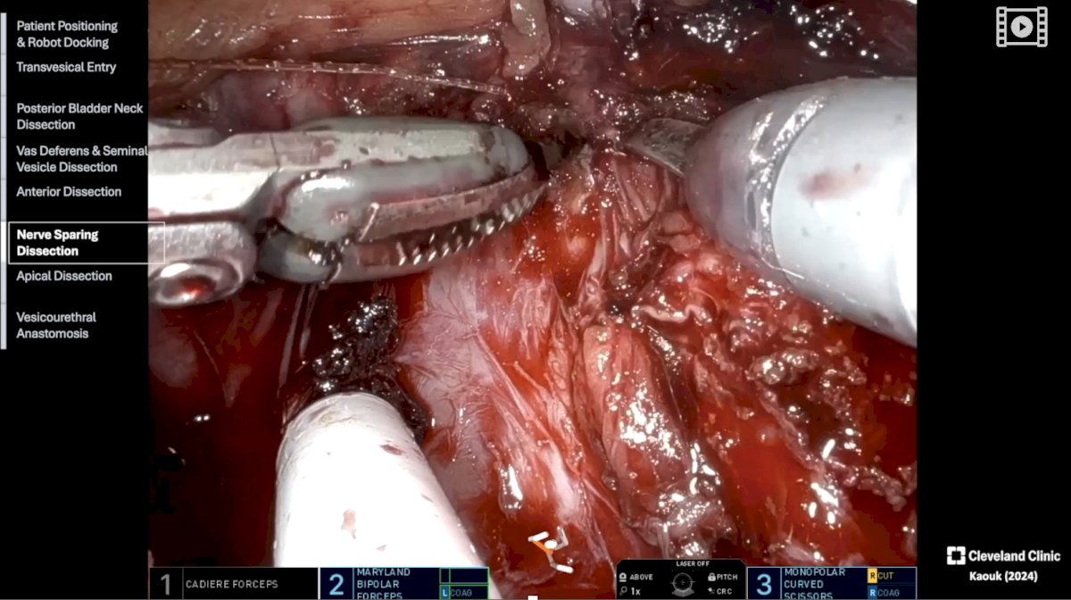 apical dissection