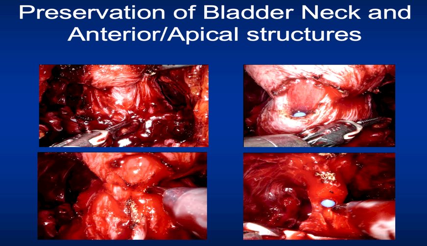 preservation of bladder neck and anterior apical structures