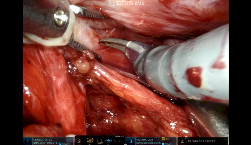 preservation of bladder neck and anterior apical structures 2