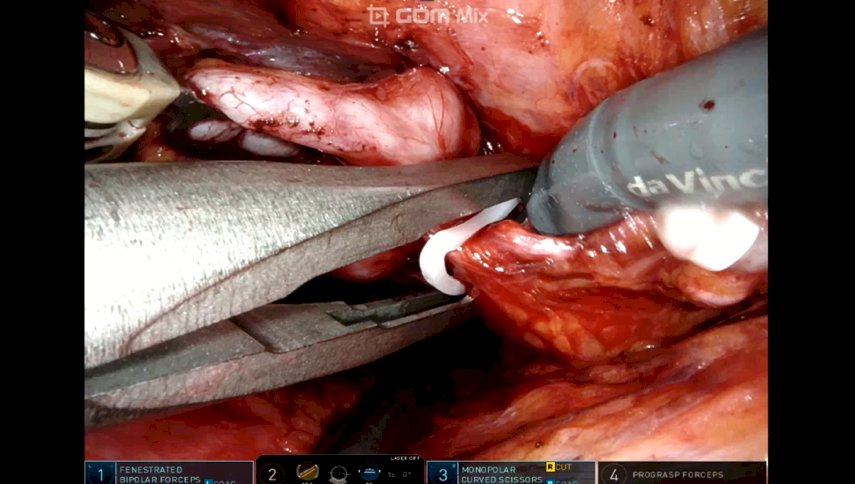 preservation of bladder neck and anterior apical structures 3