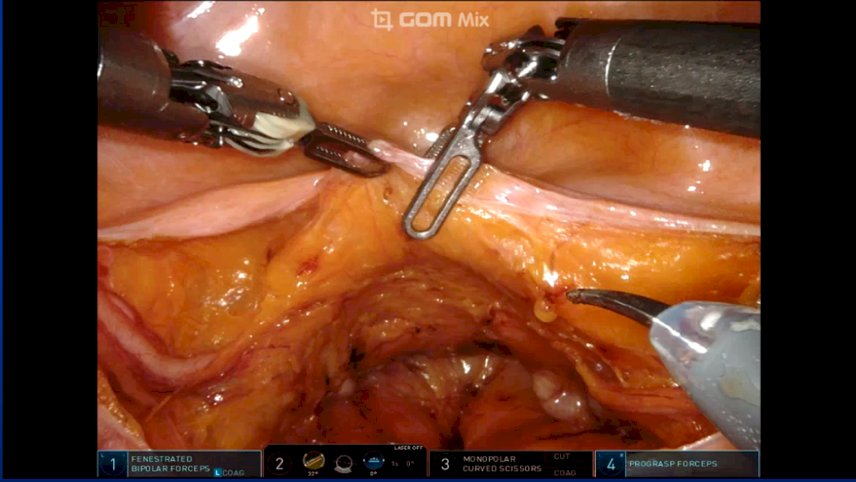 preservation of bladder neck and anterior apical structures 4