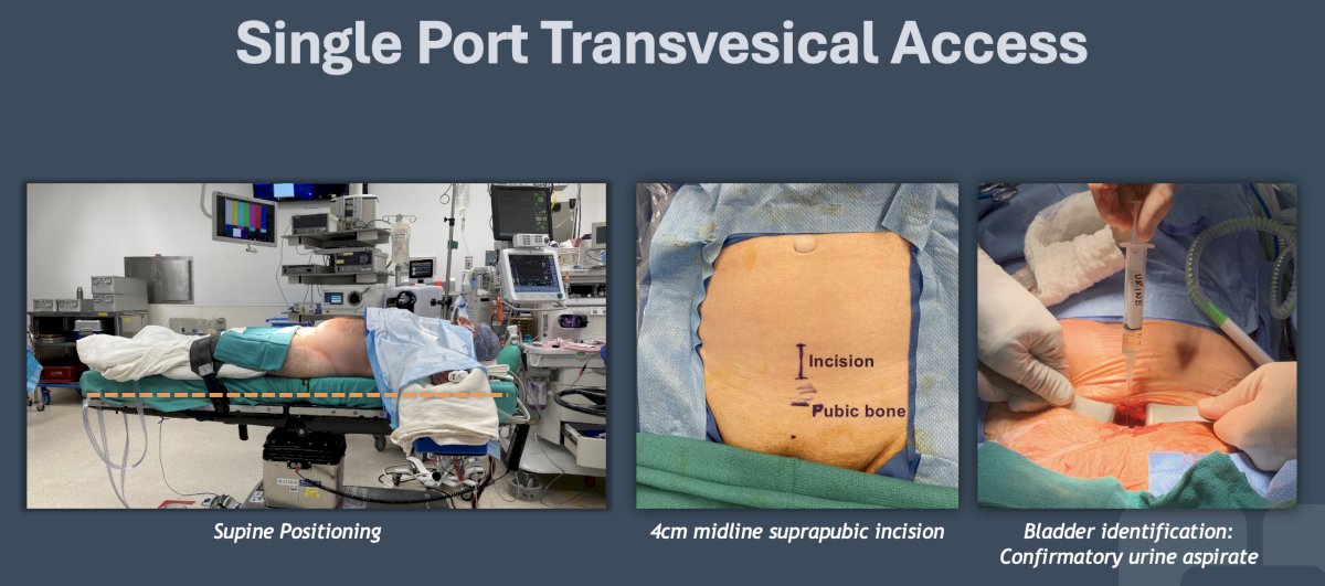 single port transvesical access