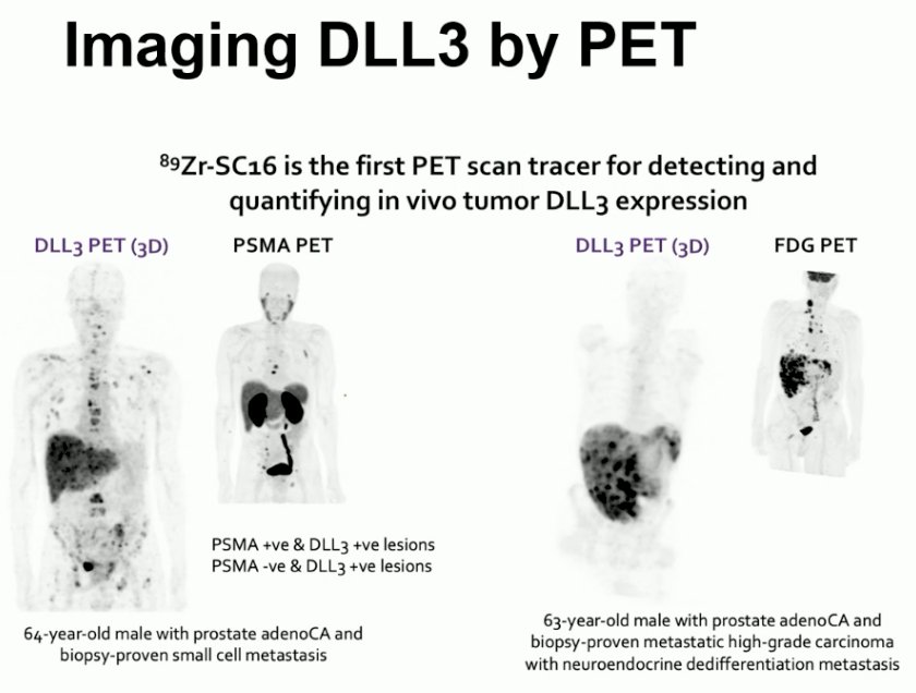 89Zr-SC16 is the first PET scan tracer for detecting and quantifying in vivo tumor DLL3 expression