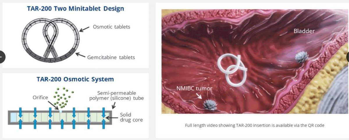 TAR-200 is a gemcitabine intravesical releasing system designed to provide sustained gemcitabine within the bladder. Phase I studies have shown clinical activity for TAR-200 in MIBC patients