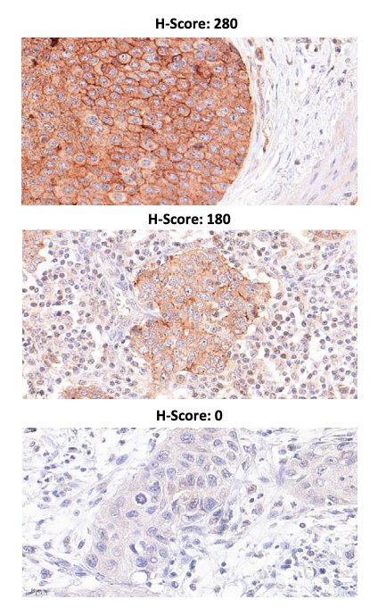 characterize associations of TACSTD2/TROP2 and NECTIN-4/NECTIN-4 protein and gene expression with morphomolecular and clinicopathological characteristics of advanced urothelial carcinoma.