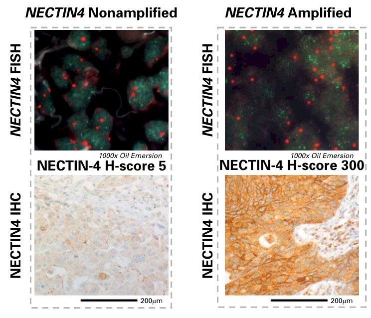 evaluated NECTIN4 amplifications as a genomic biomarker to predict enfortumab vedotin response in metastatic urothelial carcinoma