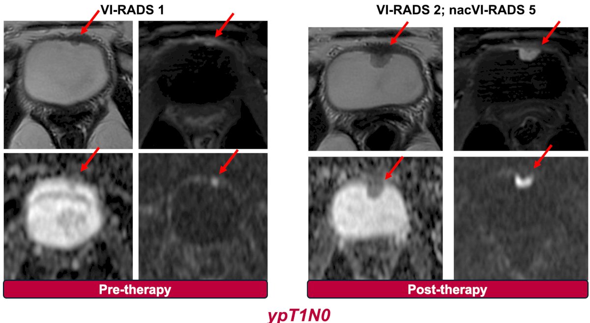 OPTIMUS trial (epacadostat followed by radical cystectomy)