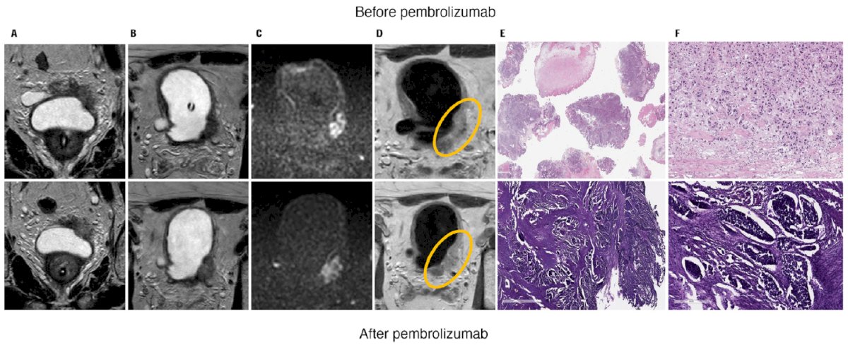 PURE-01 of poor response after adjuvant pembrolizumab as assessed by mpMRI