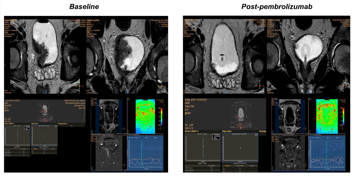 Another case shows a large baseline tumor burden, which is significantly reduced and seen clearly on mpMRI after adjuvant pembrolizumab