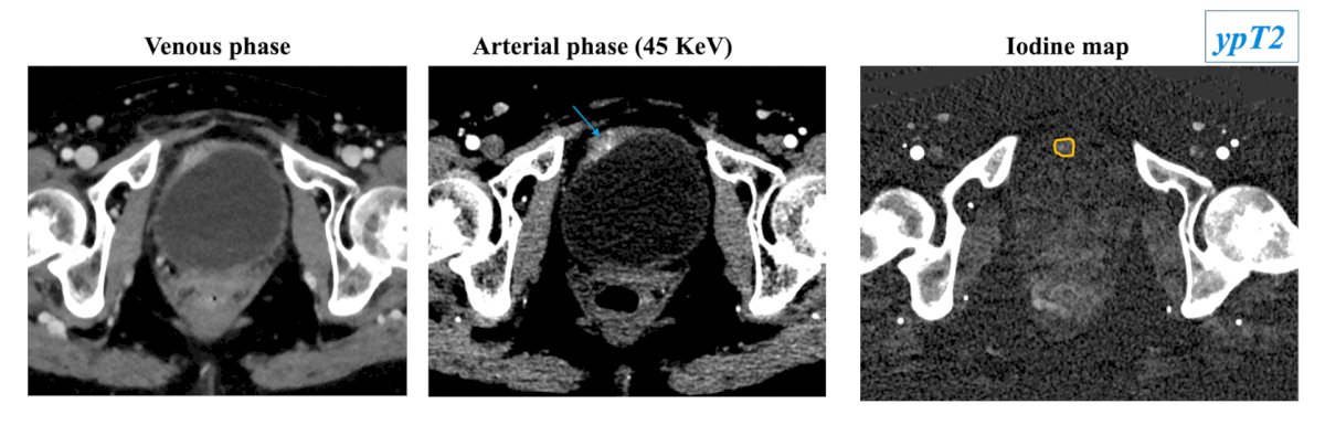 focal areas of hyperenhancement with transmural involvement at monoenergetic reconstruction are clearly visible on the iodine map in a patient with ypT2 disease