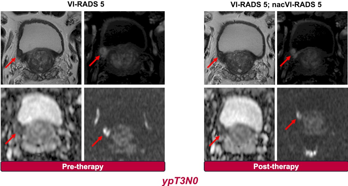 reproducibility of VI-RADS findings across various neoadjuvant therapies, starting with the SURE-01 trial (sacituzumab govitecan x 4 cycles followed by radical cystectomy)