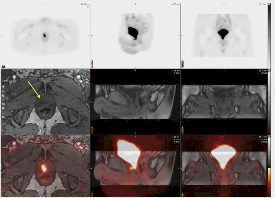 a patient who had undergone radical prostatectomy and subsequently presented with a prostate-specific antigen (PSA) level of 0.3. While either the PET alone or the MRI alone detected fibrotic changes potentially attributed to post-surgical effects, the rhPSMA 7.3 PET/MRI provided clear evidence of recurrence in the prostatic fossa