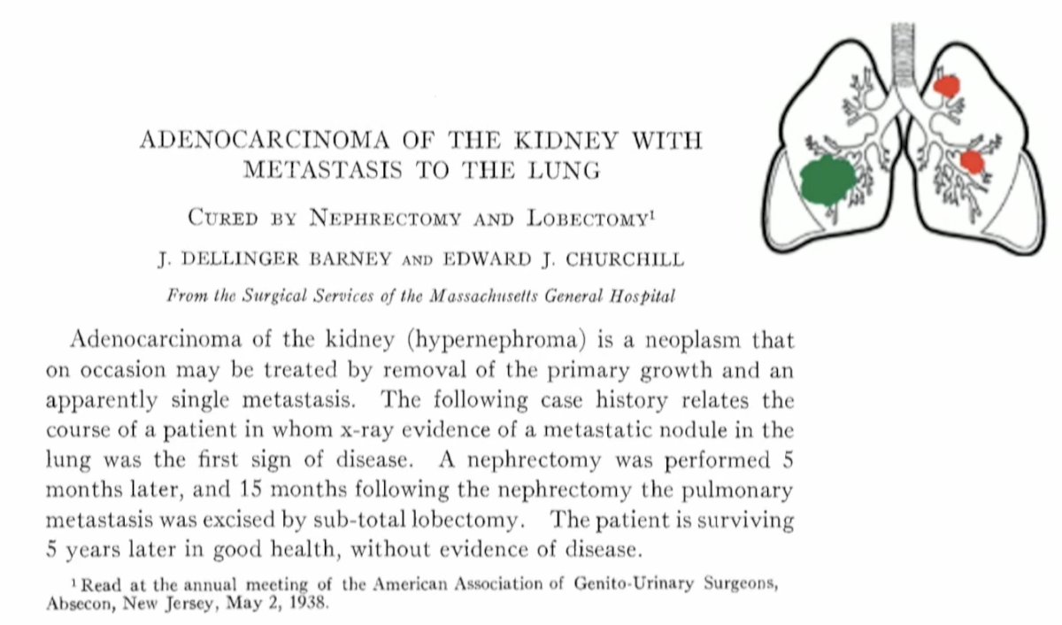 The first report of MDT for the treatment of oligometastatic RCC was published in 1938, when a patient with kidney cancer underwent a nephrectomy followed by a sub-total lobectomy for a pulmonary metastasis 10 months later and since demonstrated long-term survival.