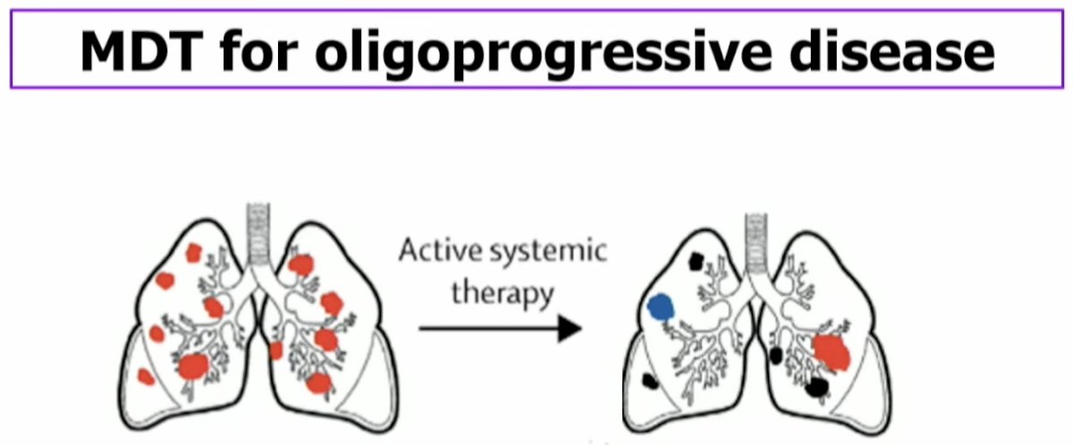 mdt for oligoprogressive disease