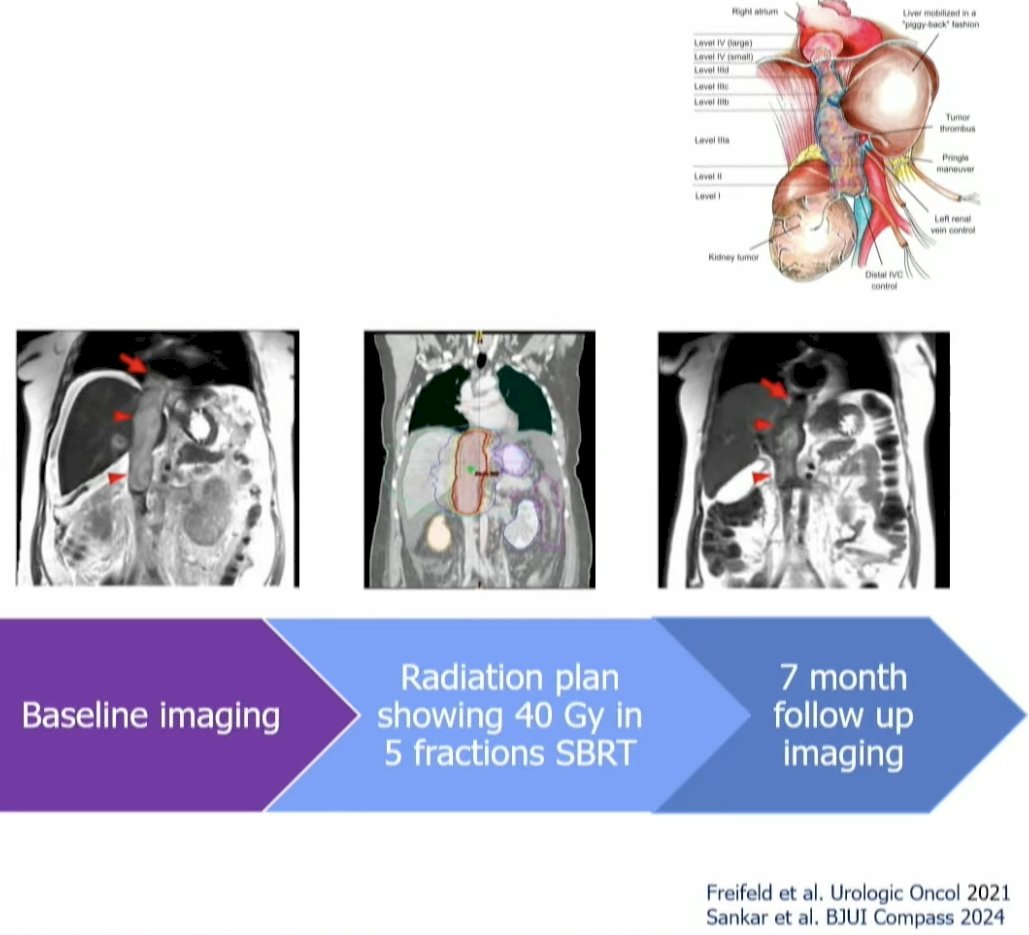 SABR for IVC tumor thrombi