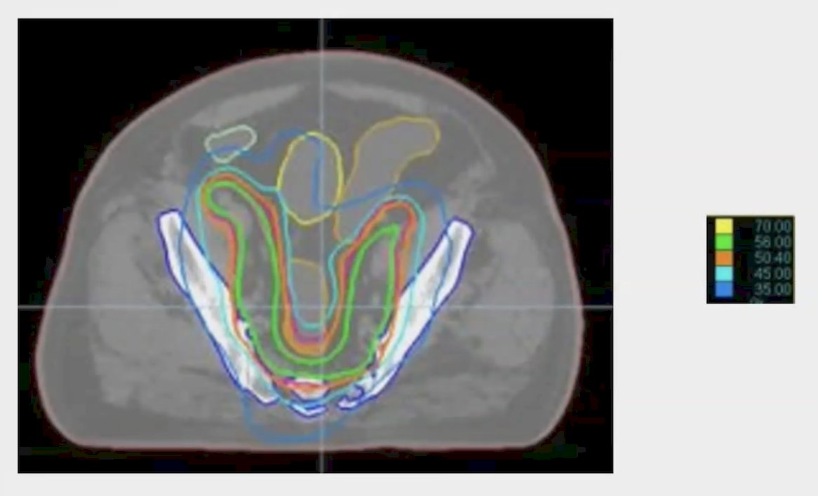 Pelvic lymph nodes were treated to a dose of 56 Gy over 28 fractions with a simultaneous integrated boost to the prostate to a total dose of 70 Gy over 28 fractions using IMRT