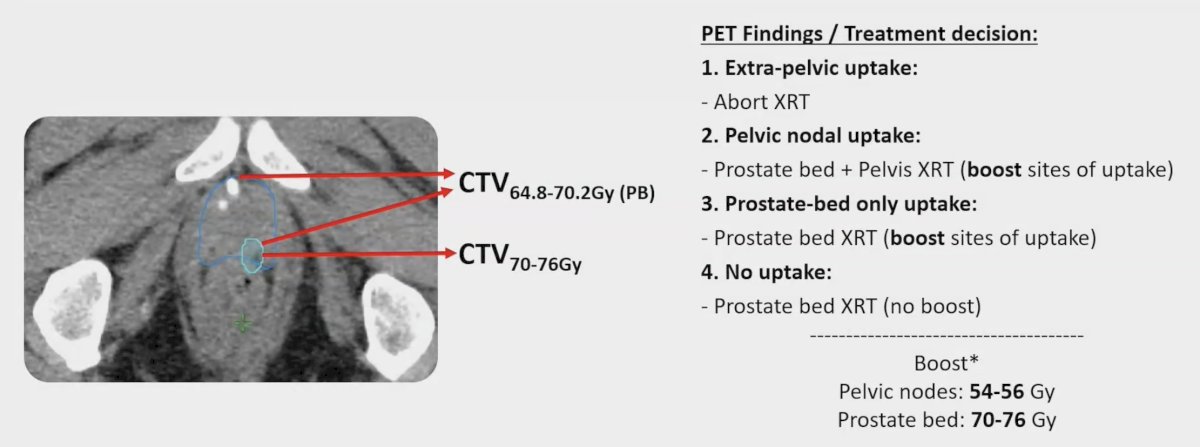 EMPIRE-2 was a prospective, randomized trial comparing 18F-Fluciclovine PET/CT (Arm 1) and 68Ga PSMA PET/CT (Arm 2)-guided post-prostatectomy radiation therapy in patients with detectable PSA after prostatectomy