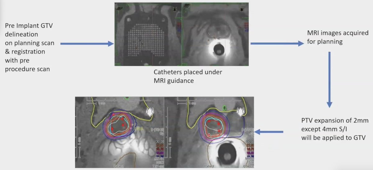  eligible patients included intermediate risk and high risk prostate cancer patients with visible gross disease (at 1 or more intraprostatic sites) comprising less than 33% of the total prostate volume on diagnostic MRI