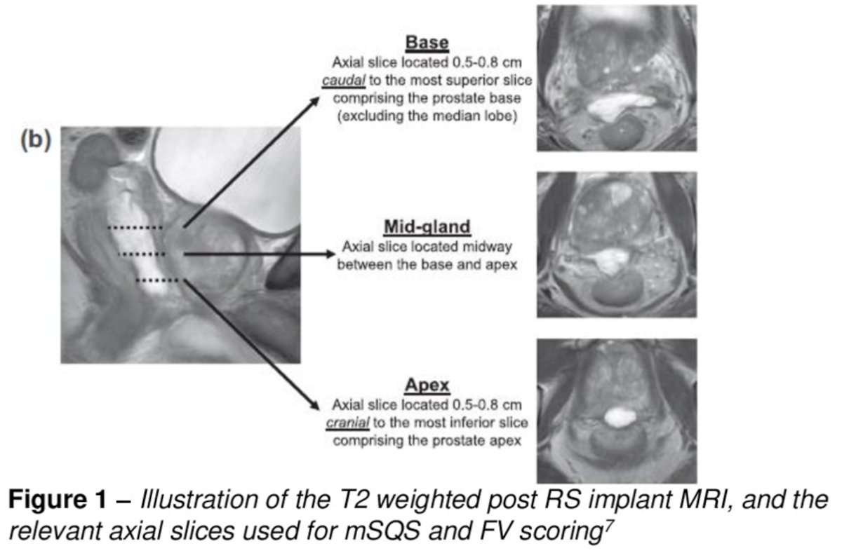 Fisher-Valuck score (symmetry), and spacer rectal wall infiltration evaluated on post implant T2-weighted MRI axial slices. Rectal wall infiltration was independently assessed by an MRI prostate specialist radiologist. Spacer Quality Score, rectal wall infiltration, and Fisher-Valuck scoring were performed according to prior publications